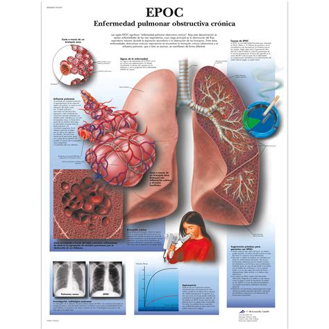 EPOC Enfermedad pulmonar obstructiva crónica - 1001851 - 3B Scientific - VR3329L - Charts and ...