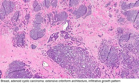 Pathology Outlines - Adenoid cystic