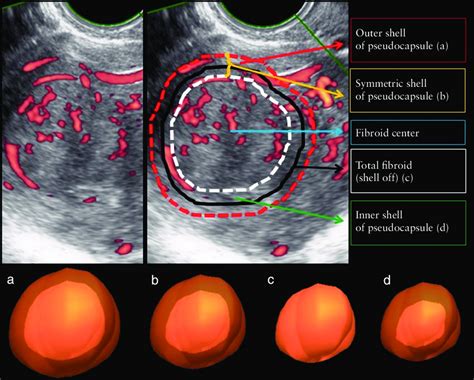 Power Doppler image of uterine fibroid, illustrating calculation of... | Download Scientific Diagram