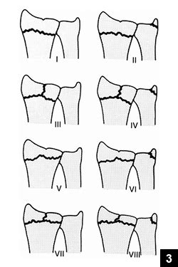 FRYKMAN CLASSIFICATION OF Radiology Classroom Facebook, 56% OFF