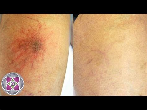 Spider Veins Legs Treatment – SITE Onpron2lio