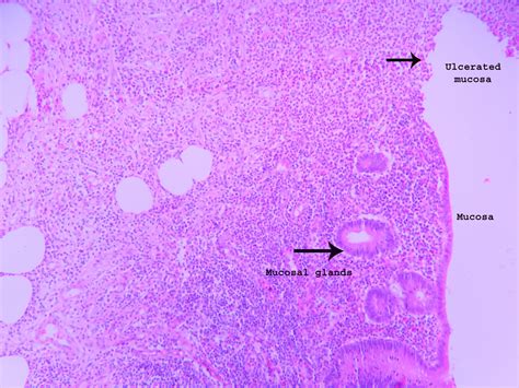 Acute Appendicitis – Histopathology.guru