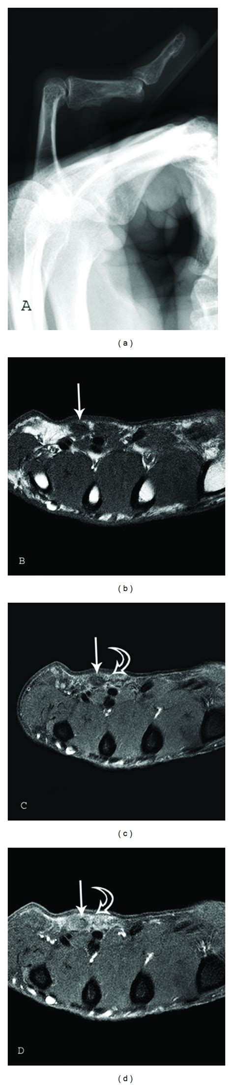 Palmar Fibromatosis. Lateral radiograph (a) of the right hand 5th... | Download Scientific Diagram