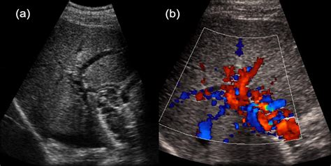 Portal Vein Thrombosis - The American Journal of Medicine