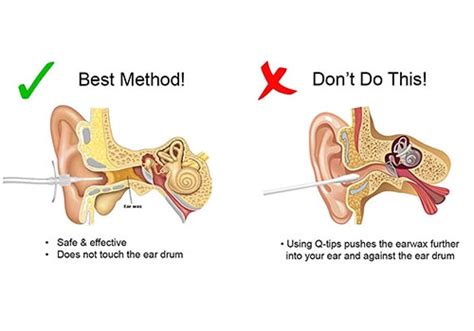 Ear Wax Myths And Facts – Dr Shreha Pathak ENT Specialist