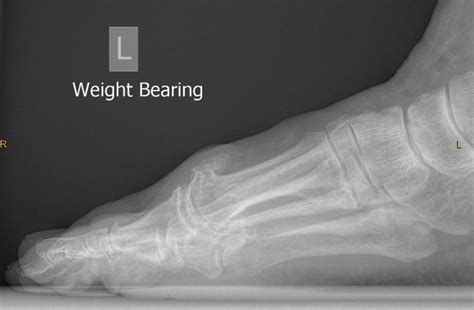 1st MTP Joint (Big Toe Joint) Fusion | Dr Mike Smith | Adelaide