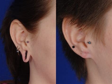 Gauged earlobe repair