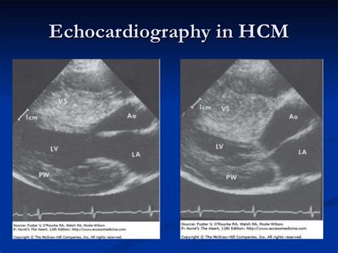 HYPERTROPHIC OBSTRUCTIVE CARDIOMYOPATHY (HOCM)