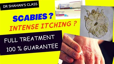 Scabies Treatment | 100 % sure treatment #scabies #treatmentplan #dermatology - YouTube