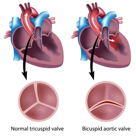 Heart Valve Surgery - Treatment in Israel | D.R.A Medical