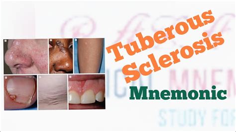 Tuberous Sclerosis Mnemonic - YouTube