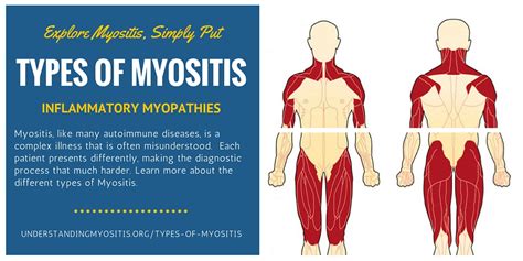 Types of Myositis - Myositis Support and Understanding