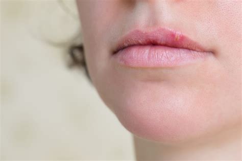 Bumps on Lips: Common Causes and Treatment Tips