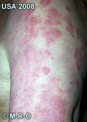 morgellons afflicted skin lesions wounds photos