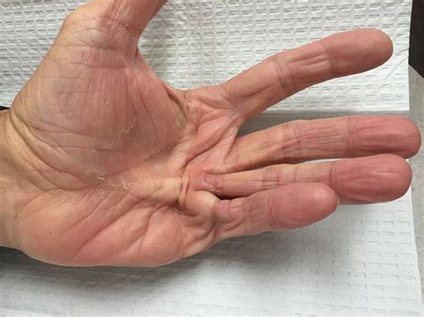 Dupuytrens Contracture Treatment by Dr Erickson in Raleigh