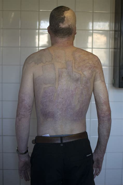 Photographer pictures of scars people received from near-death ...