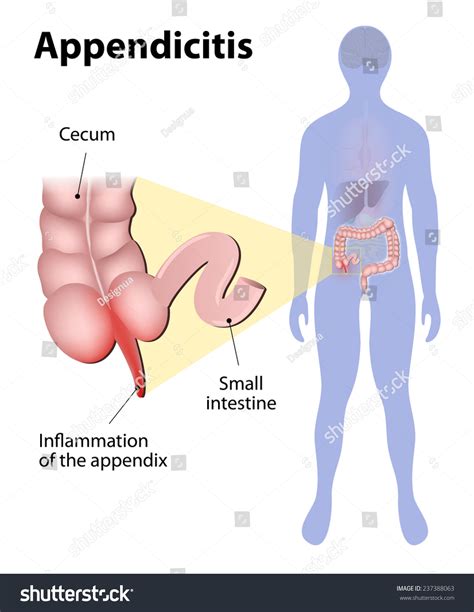 Appendicitis Is Inflammation Of The Appendix. Large Intestine And Appendix Highlighted On The ...