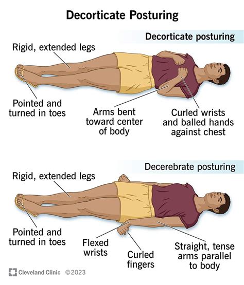 Decerebrate Posturing: What It Is, Causes, & Treatment