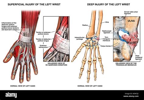 Ligament Injury