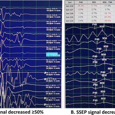 A, B. MEP, SSEP alerting. Motor-evoked potentials (panel A) and ...