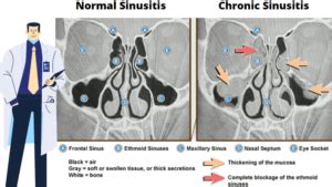 Chronic Sinusitis CT Scan | 2 Safety Issue | World Health