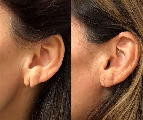 Before & After Photos Earlobe Repair 3 | NYC