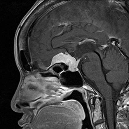 Planum sphenoidale | Radiology Reference Article | Radiopaedia.org