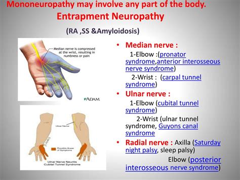 Ulnar Neuropathy