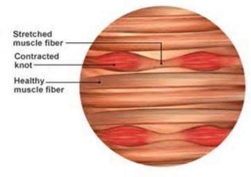 Muscle Knots - What is?, Causes, Prevention, Treatment