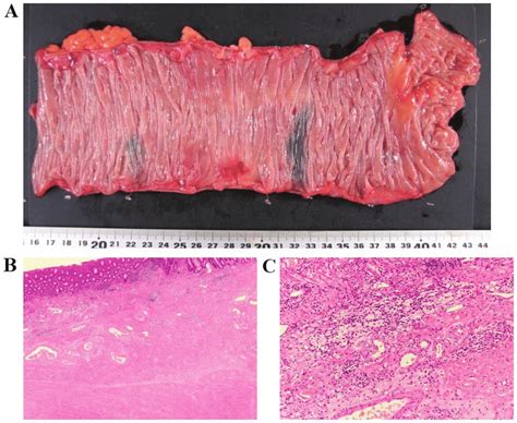 Operative specimen and histological profile of the primary tumor. (A ...