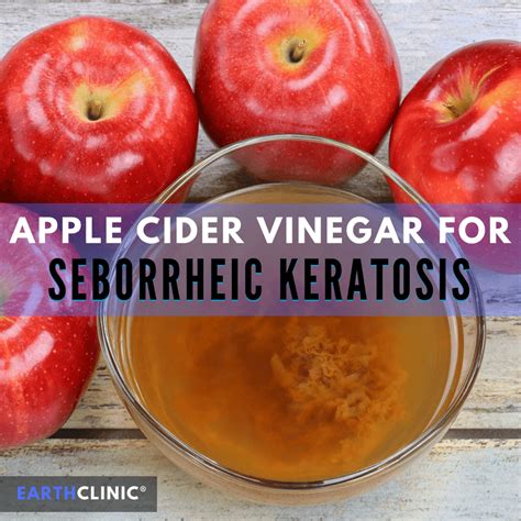 Discover the Power of Apple Cider Vinegar for Seborrheic Keratosis