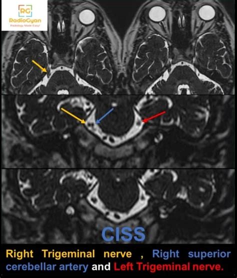 Trigeminal Ganglion Mri