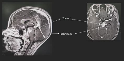 Surgical Technology – Brain stem tumor in a child – Dr Savitr Sastri BV