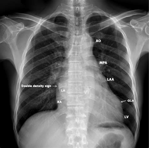 Anterior Chest X Ray