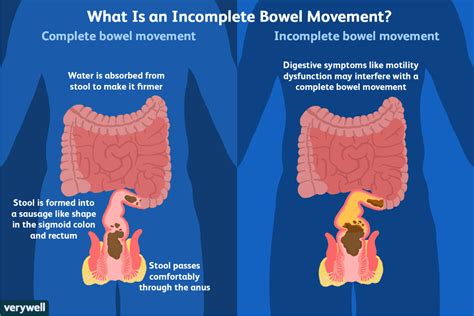 How to Reduce Symptoms of Incomplete Defecation | Sigmoid colon, Bowel movement, Symptoms