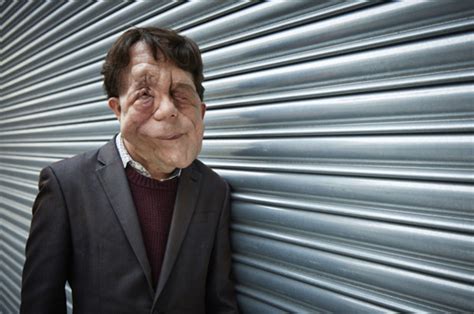 Disfigured actor Adam Pearson told he "should have be burned alive at birth" | Daily Star