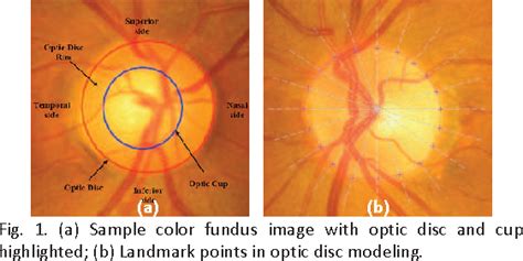 Figure 1 from Automated segmentation of optic disc and optic cup in ...