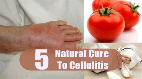 5 Home Remedies for Cellulitis | By Top 5. - YouTube