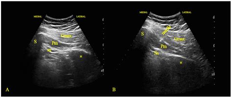 Piriformis Syndrome Ultrasound | My XXX Hot Girl