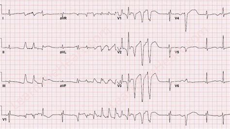 Polymorphic Non-Sustained Ventricular Tachycardia ECG | Learn the Heart