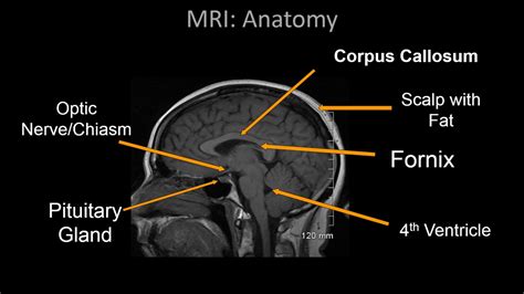 Normal Brain MRI Anatomy - Neuroradiology Made simple - YouTube