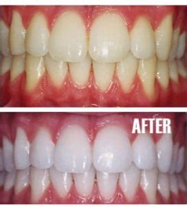 teeth-whitening-before-and-after-up-and-down - Winchester Dental