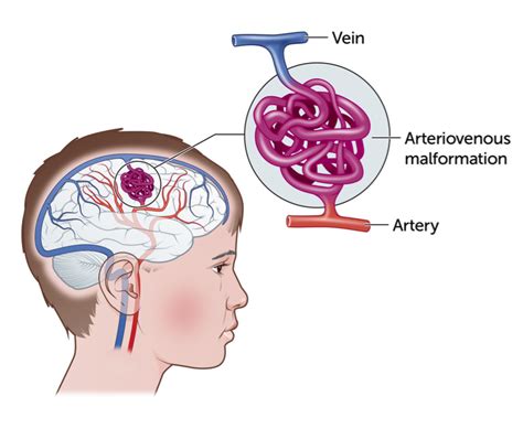 Avm Brain Hemorrhage