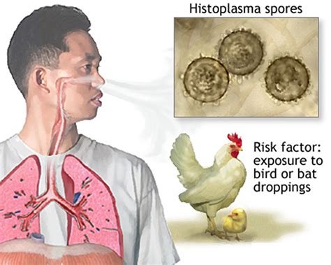 Histoplasmosis - Causes, Symptoms, Diagnosis, Prognosis, Treatment