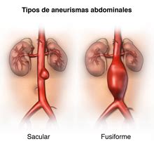 Abdominal Aortic Aneurysm