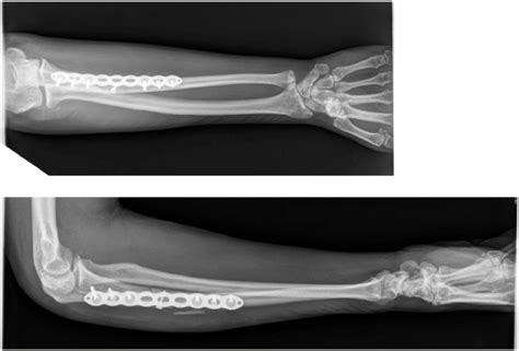 Adult Monteggia Fracture Dislocation, Bado Type I. Right arm... | Download Scientific Diagram