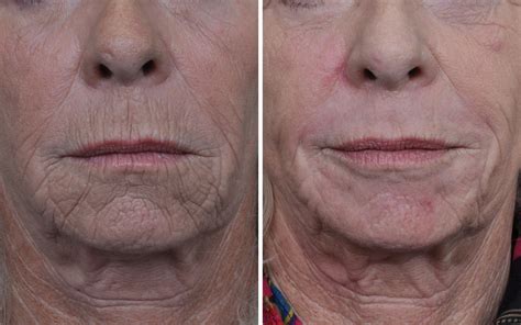 Laser Skin Resurfacing Before & After | Annapolis Plastic Surgery