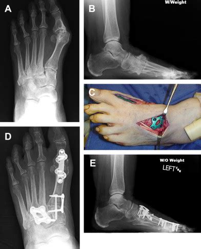 Surgical Correction of Midfoot Arthritis With and Without Deformity ...