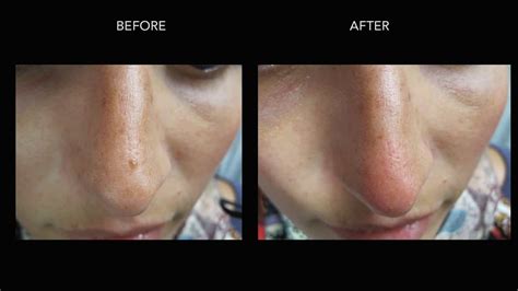 Mole Removal: Before & After Photos | DermMedica