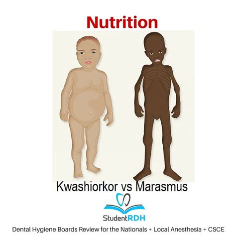 Q: Which disease is related to severe protein deficiency and is ...